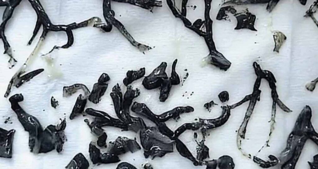 87-yasindaki-adamin-akcigerinden-agac-cikardilar-D3wKRJYv